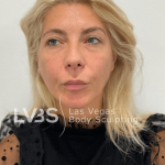 Lip Lift Before & After Patient #589