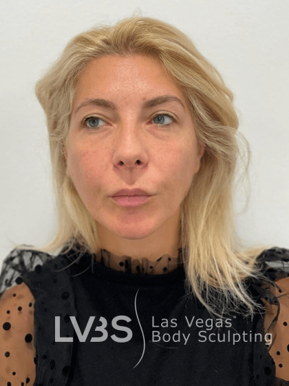 Lip Lift Before & After Patient #589