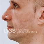 Blepharoplasty Before & After Patient #598