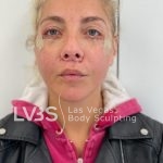 Lip Lift Before & After Patient #589