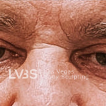Blepharoplasty Before & After Patient #595