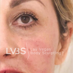 Facelift Before & After Patient #601