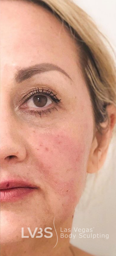 Facelift Before & After Patient #601
