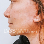 Facelift Before & After Patient #605