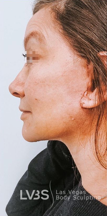 Facelift Before & After Patient #605