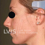 Neck Lift Before & After Patient #610