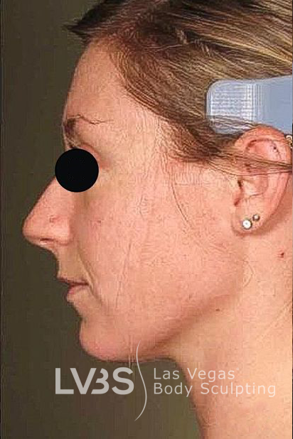 Neck Lift Before & After Patient #610