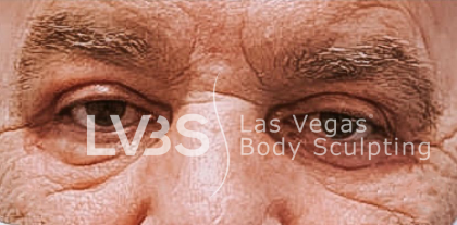 Blepharoplasty Before & After Patient #595