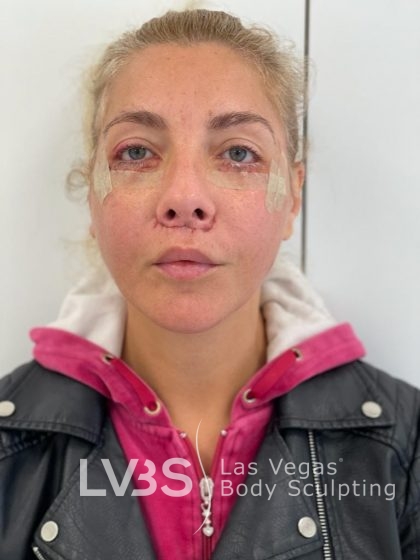 Lip Lift Before & After Patient #589