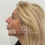 Lip Lift Before & After Patient #589