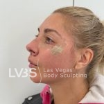 Lip Lift Before & After Patient #589
