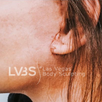 Facelift Before & After Patient #605