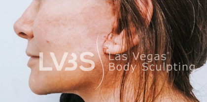 Facelift Before & After Patient #605