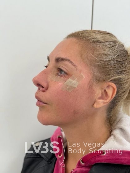 Lip Lift Before & After Patient #589