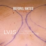 Fat Transfer to Breast Before & After Patient #671