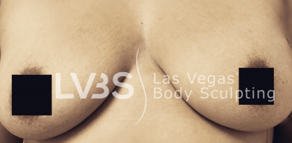 Breast Augmentation Before & After Patient #710