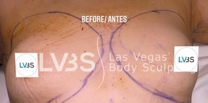Fat Transfer to Breast Before & After Patient #671