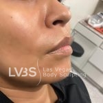 Lip Fillers Before & After Patient #643