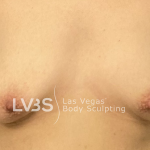 Breast Augmentation Before & After Patient #714