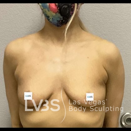 Breast Augmentation Before & After Patient #651