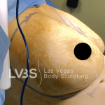 Breast Augmentation Before & After Patient #717