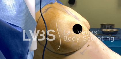 Breast Augmentation Before & After Patient #717