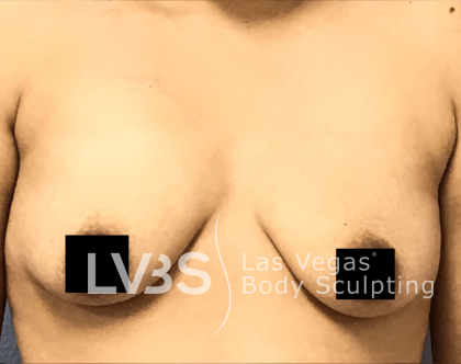 Fat Transfer to Breast Before & After Patient #655