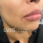 Lip Fillers Before & After Patient #643