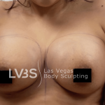Fat Transfer to Breast Before & After Patient #655