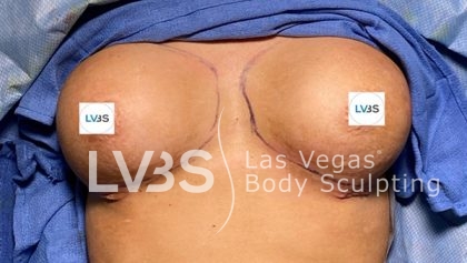 Breast Augmentation Before & After Patient #674