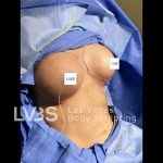 Breast Augmentation Before & After Patient #651