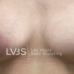 Breast Augmentation Before & After Patient #714