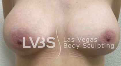 Breast Augmentation Before & After Patient #714