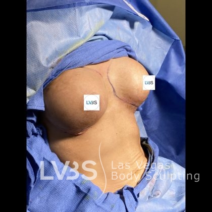 Breast Augmentation Before & After Patient #651