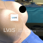 Breast Augmentation Before & After Patient #717