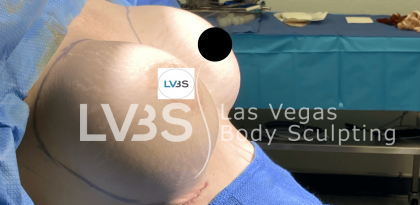 Breast Augmentation Before & After Patient #717