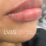 Lip Fillers Before & After Patient #722