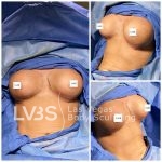 Breast Augmentation Before & After Patient #677