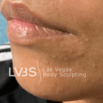 Lip Fillers Before & After Patient #722