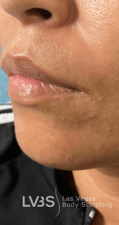 Lip Fillers Before & After Patient #722