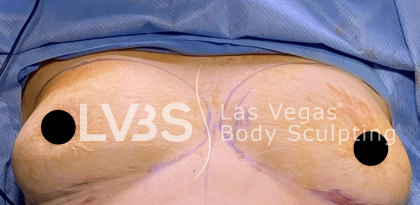 Breast Augmentation Before & After Patient #717