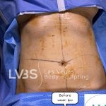 Liposuction Before & After Patient #663