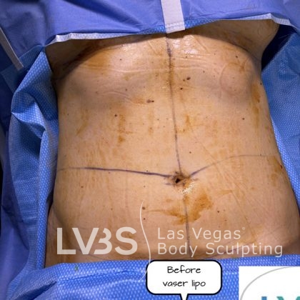 Liposuction Before & After Patient #663