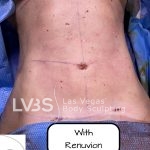 Liposuction Before & After Patient #663