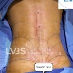 Liposuction Before & After Patient #663