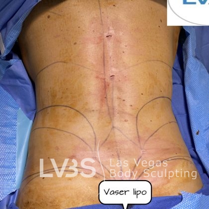 Liposuction Before & After Patient #663