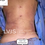 Liposuction Before & After Patient #663