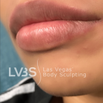 Lip Fillers Before & After Patient #722