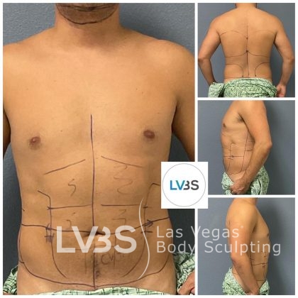 Liposuction Before & After Patient #682