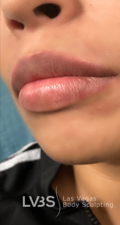 Lip Fillers Before & After Patient #722
